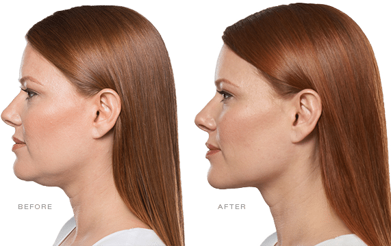 KYBELLA®