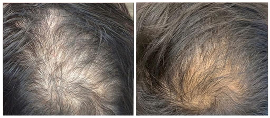 PRP Hair Restoration before and after