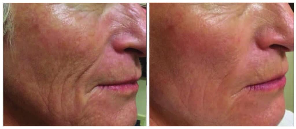 SkinPen Microneedling before and after