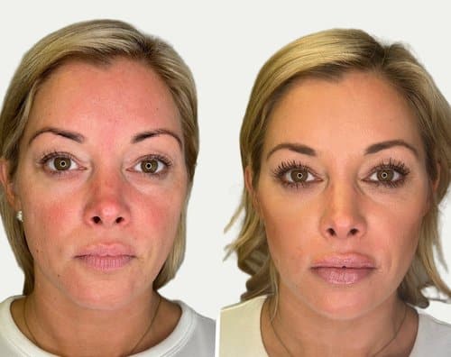 Facial Rebalancing before and after