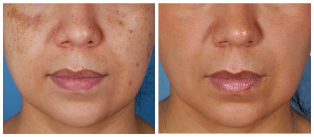 chemical peel before and after