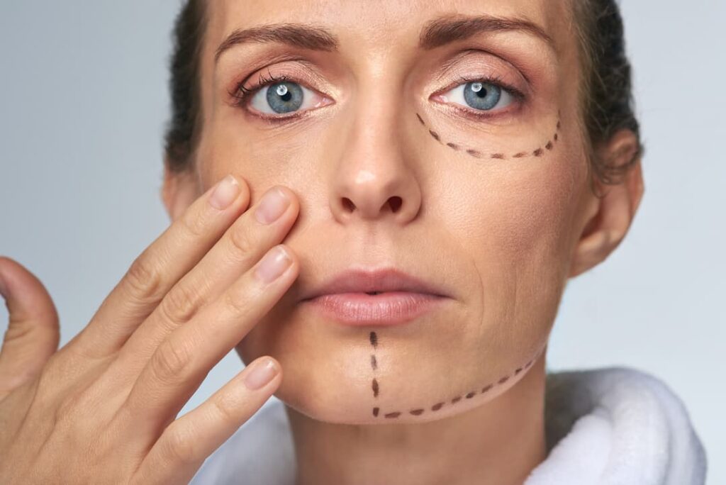 Dermal Fillers - Perforation drawing lines on woman's face before procedure