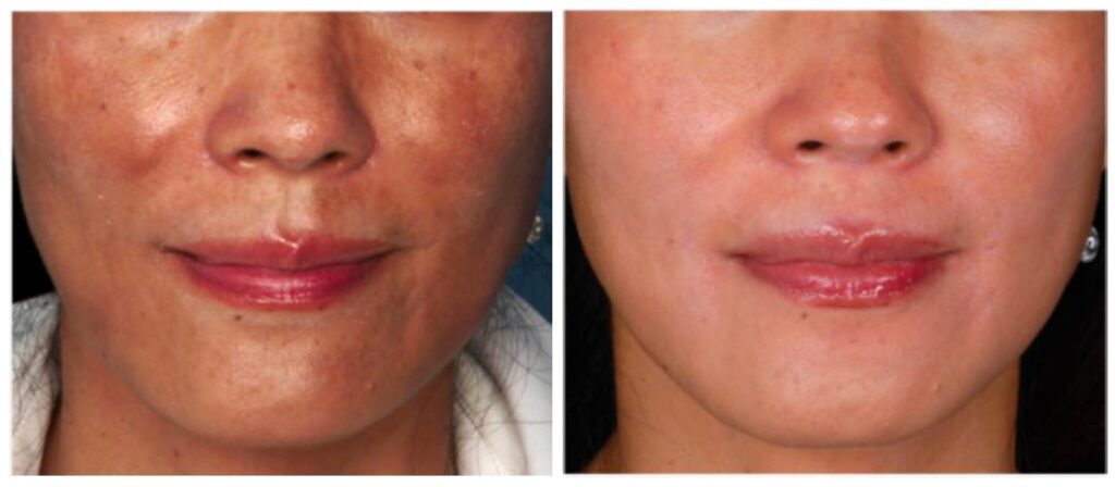 Medical Skincare before and after